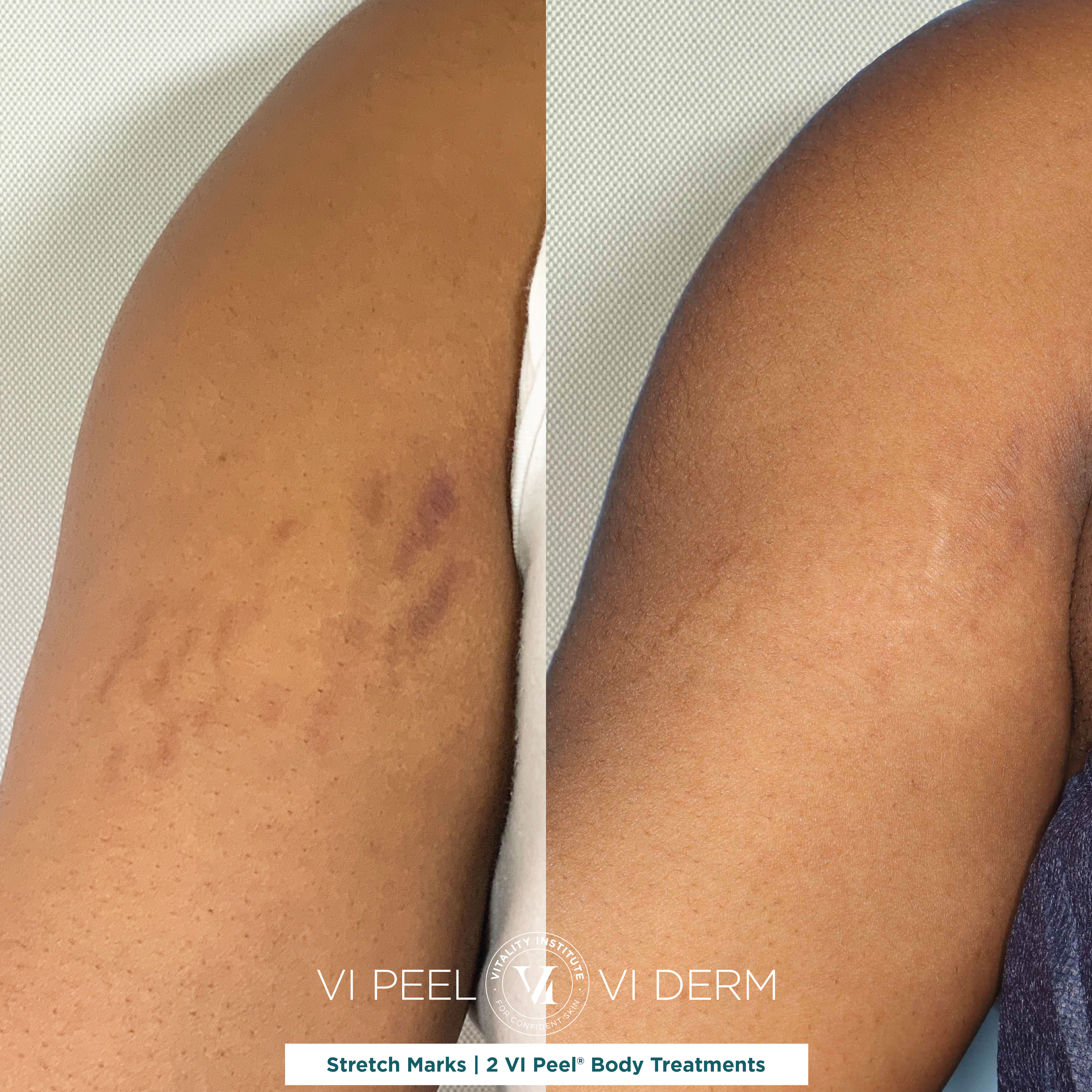 Chemical Peels